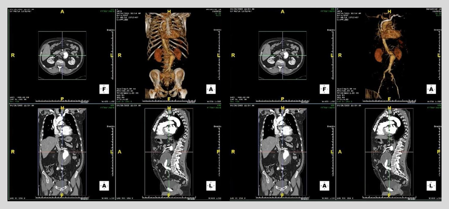Bone-removal-image-001 Bone-removal-image-001
