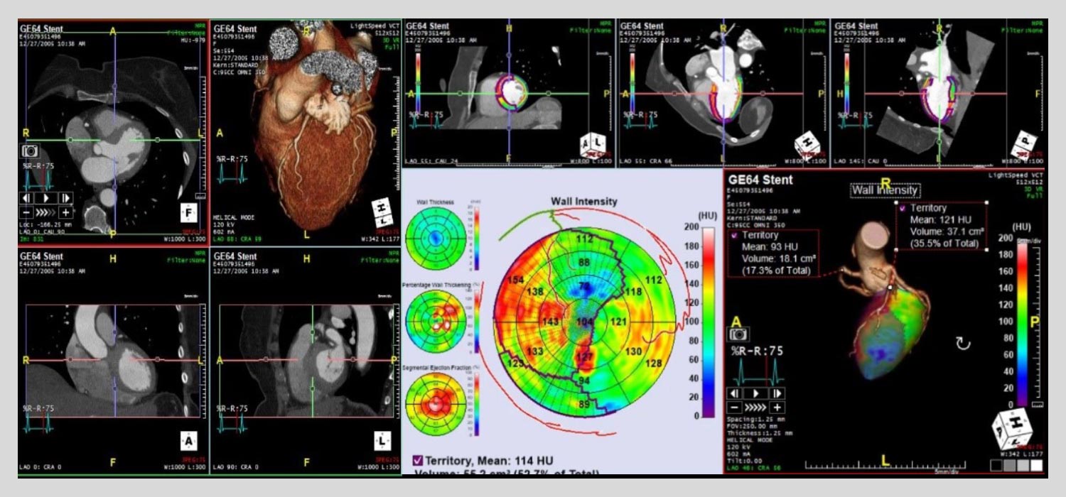 CT-Cardiac CT-Cardiac