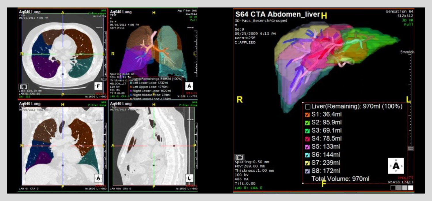 Lobular-lung-liver-001 Lobular-lung-liver-001
