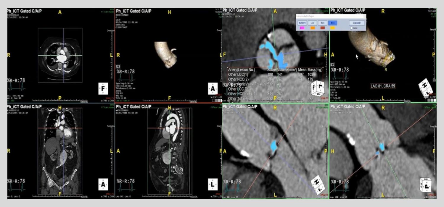 TAVR-Image TAVR-Image